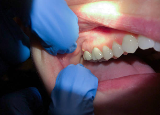 Best Emergency Dental Extractions in Gloverville, SC